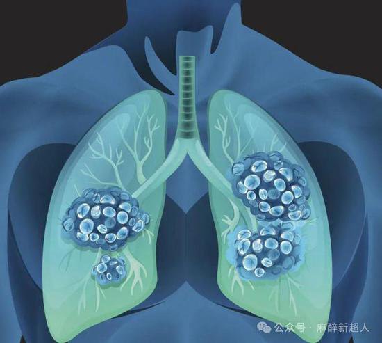 规培<em>笔记</em>｜限制性肺部疾病的麻醉评估<em>与管理</em>
