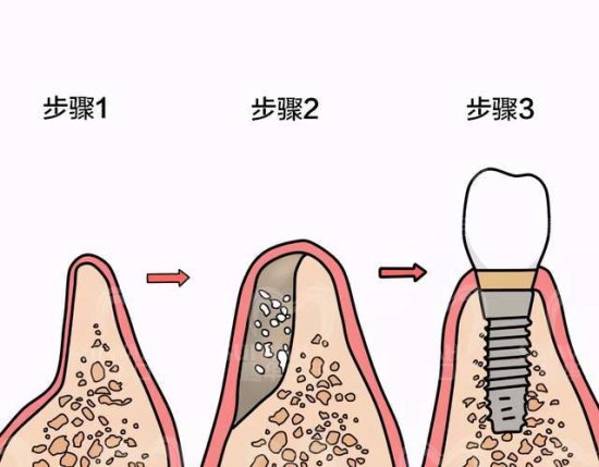 做种植牙时，为什么医生还要求<em>植</em>骨？<em>植牙</em>补<em>骨粉</em>的用途是什么？