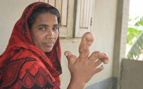 孟加拉女子患罕见病 手上<em>长水泡</em>肿胀大如球