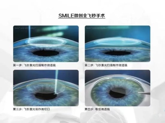 明日9时，<em>濮阳</em>市眼科医院为您揭开全飞秒手术的神秘面纱！