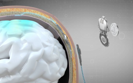 首例无线微创脑机接口临床试验成功 患者可实现脑控抓握