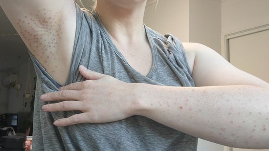 澳洲女子医美<em>激光脱毛</em>烧伤皮肤，有顾客留下永久性疤痕