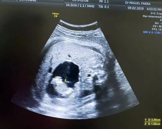<em>刚出生的婴儿</em>肚子里，竟然还有一个胎儿 | 罕见的胎中胎
