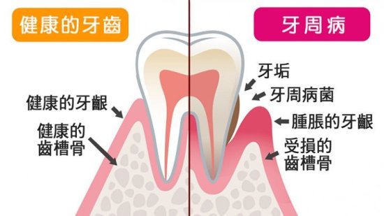 身体在什么情况下不能种牙？<em> 牙周</em>病可以种植牙吗？对金属过敏，...